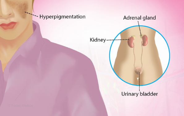 How to Recognize Adrenal Insufficiency Symptoms in NYC