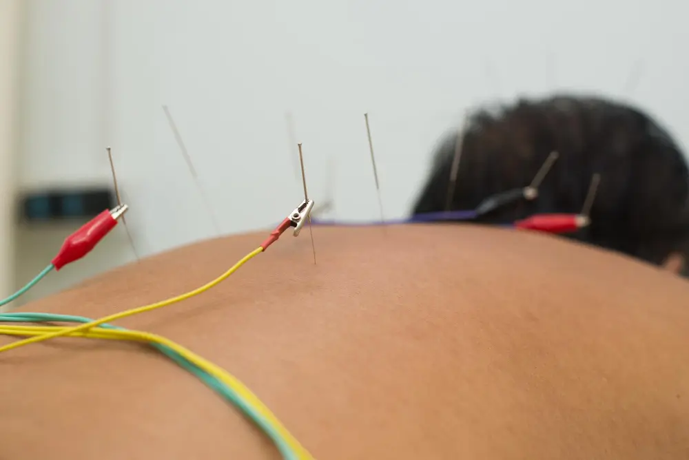Acupuncture Treatment in NYC