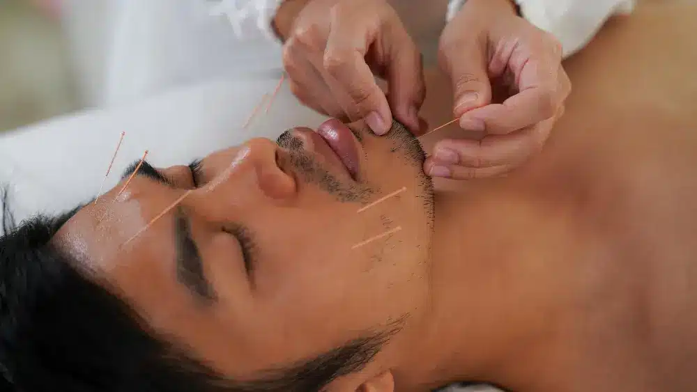 acupuncture treatments
