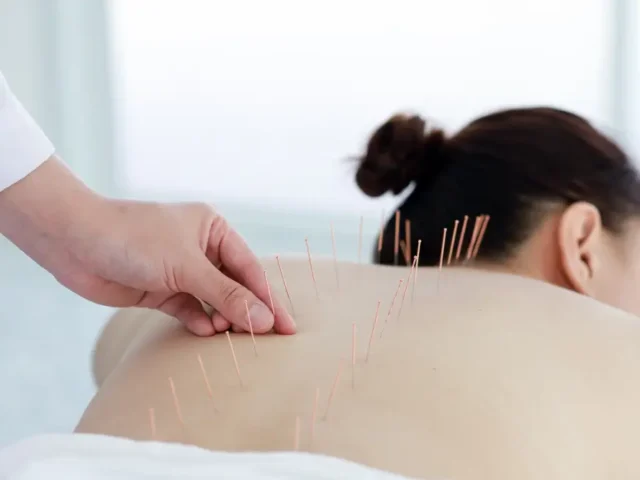 How acupuncture can help you heal naturally without medications