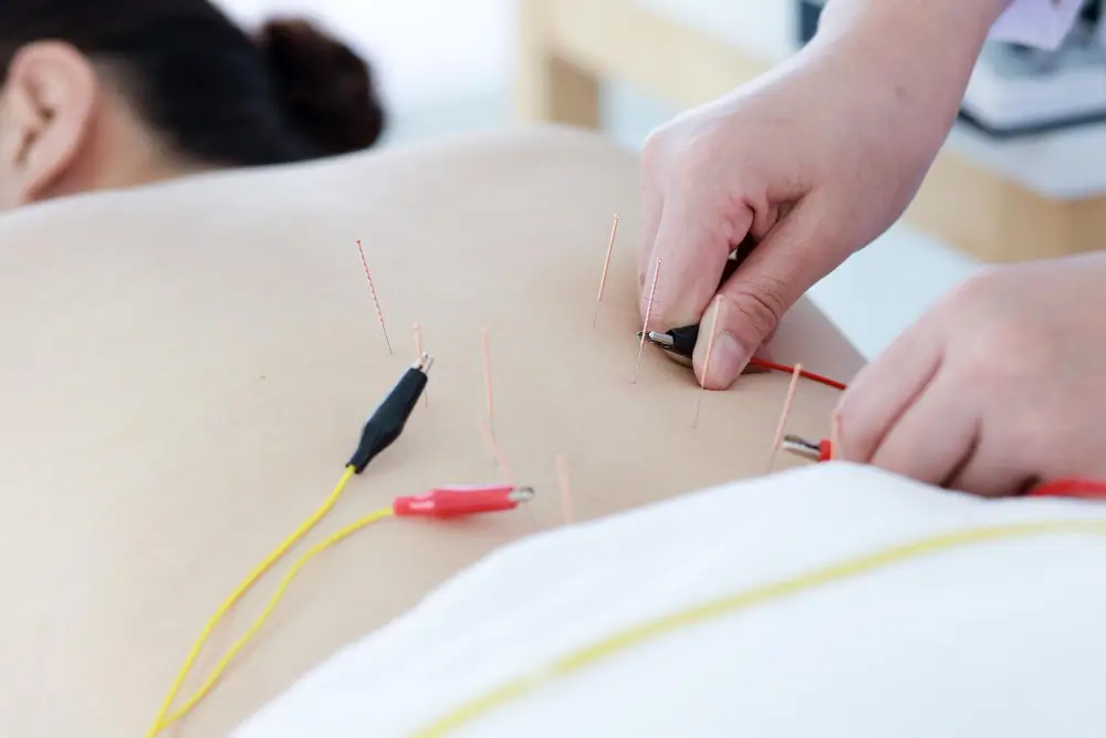 acupuncture treatment for back pain