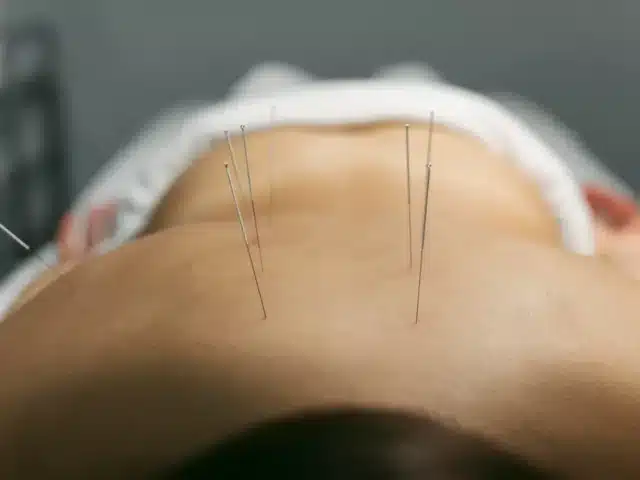 5 Surprising Benefits of Acupuncture You Didn’t Know About