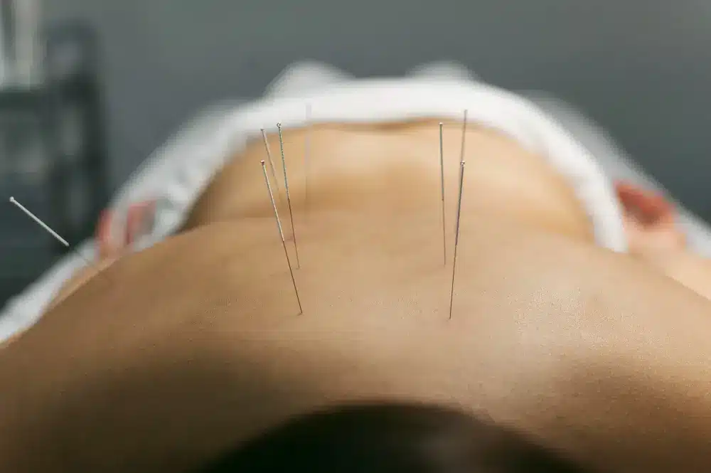 Acupuncture process