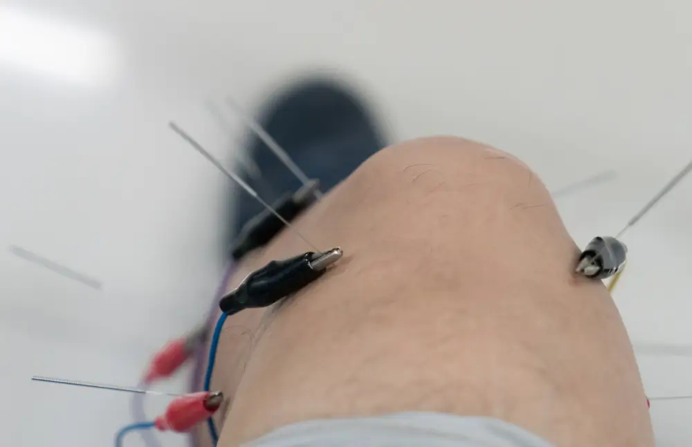 Acupuncture Treatment in NYC