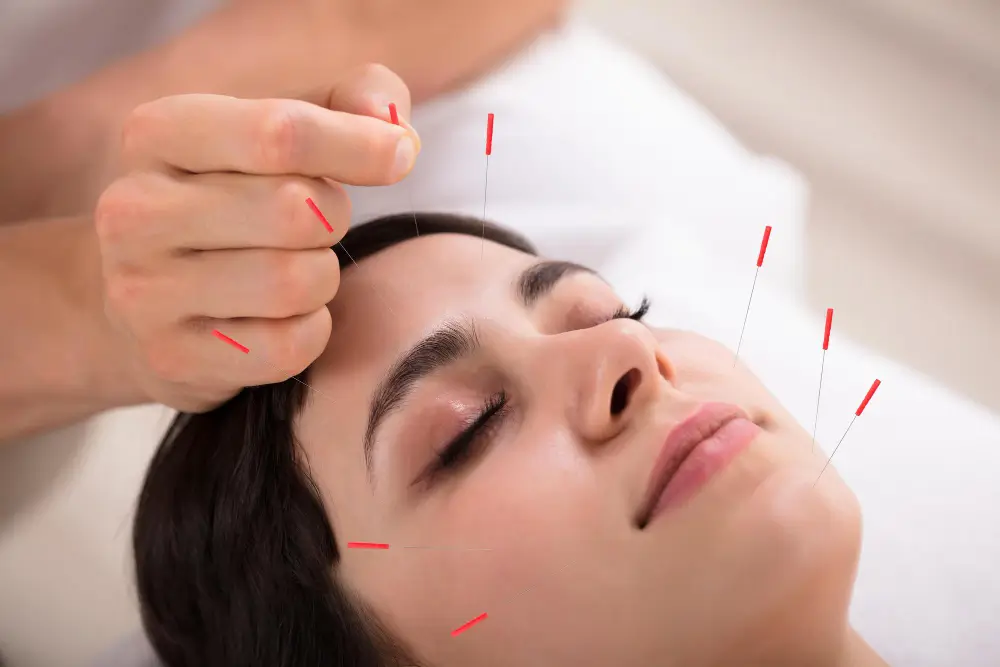 acupuncture treatments