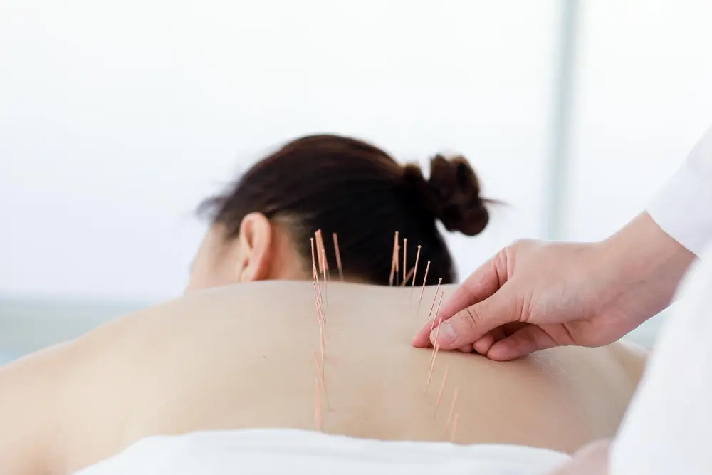 Acupuncture Treatment in NYC