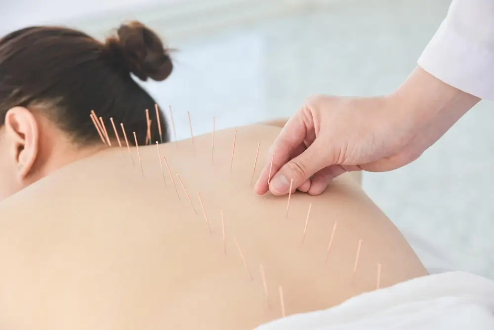 Acupuncture Treatment in NYC