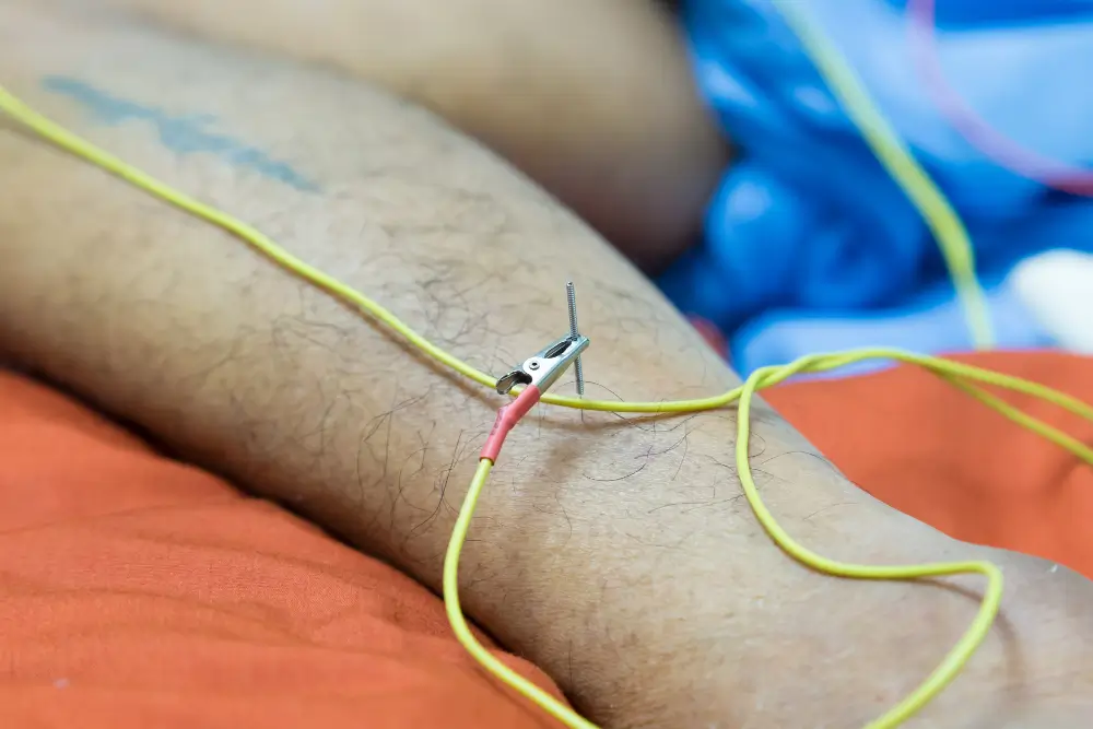 benefits of acupuncture