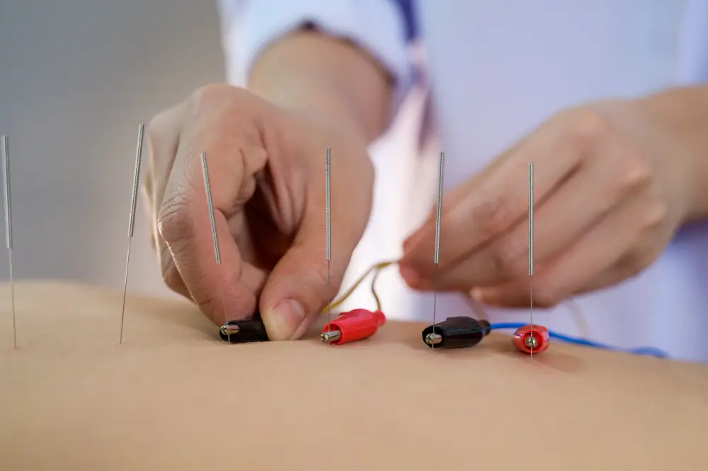 Acupuncture Treatment in NYC