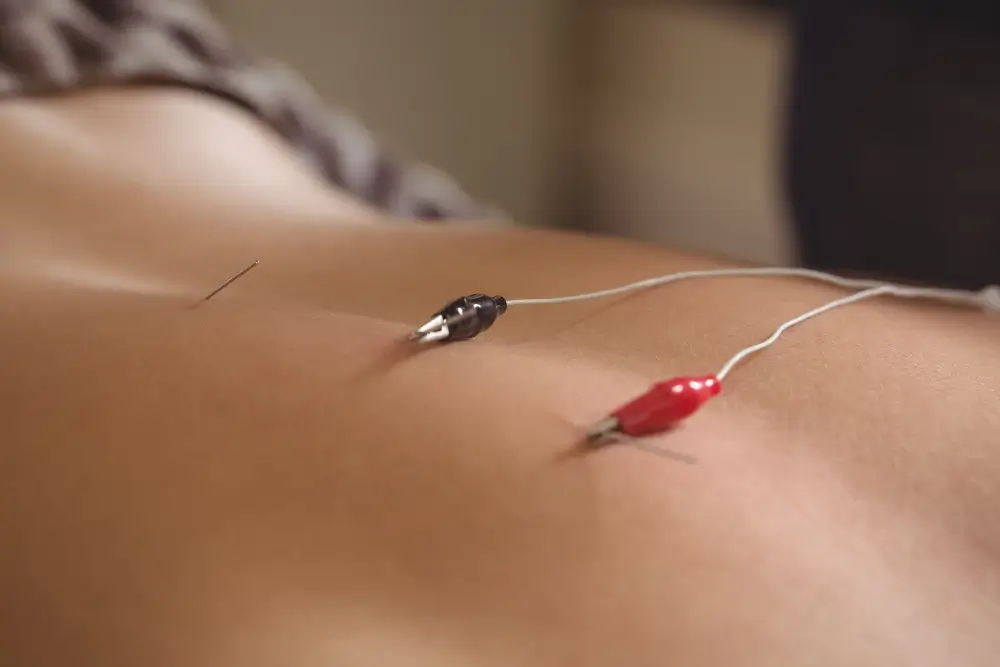 Acupuncture Treatment Near Me