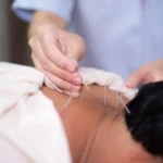 Acupuncture for Cervical Dizziness Relief