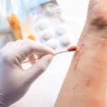 Early vs Late Lyme Disease