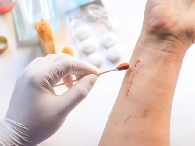 Early vs Late Lyme Disease: Why Timely Treatment Matters