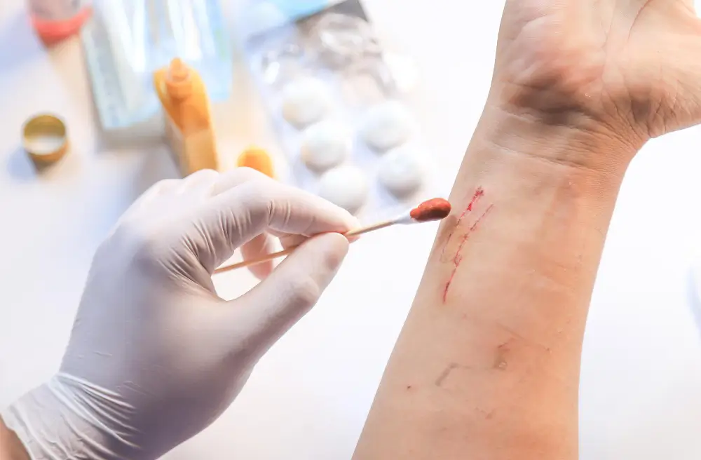 Early vs Late Lyme Disease