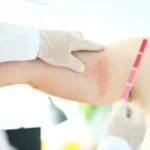 Lyme Disease Affects