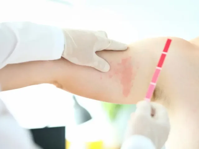 How Lyme Disease Affects the Brain, Joints, and Immune System