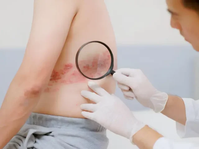 Lyme Disease Stages Explained: From Tick Bite to Chronic Symptoms