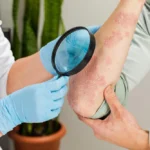What Is Lyme Borreliosis