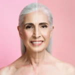 Botox vs Aging