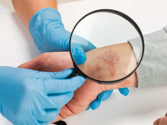 Understanding Lyme Disease Co-Infections: Babesia, Bartonella & More